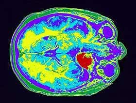 Brain imaging technology in memory suppression study